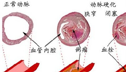 动脉硬化